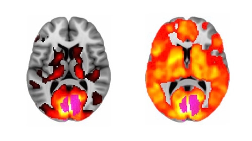 LSD brain scan